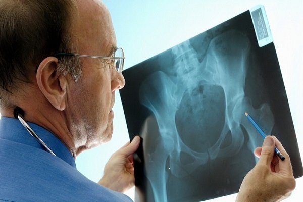 راه اندازی کلینیک های مدیریت شکستگی برای پیشگیری از پوکی استخوان