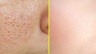 بهترین راه برای درمان منافذ باز پوست