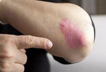 از بیماری «پسوریازیس» چه می دانید - خبرگزاری مهر ایران و جهان