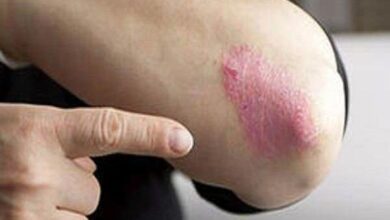 از بیماری «پسوریازیس» چه می دانید - خبرگزاری مهر ایران و جهان