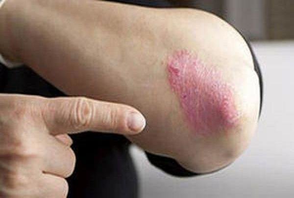 از بیماری «پسوریازیس» چه می دانید - خبرگزاری مهر ایران و جهان