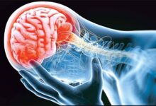 علائم سکته مغزی چیست؟ / سکته مغزی محدود به سن خاصی نیست