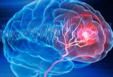 سالانه 150 هزار نفر در کشور دچار سکته مغزی می شوند