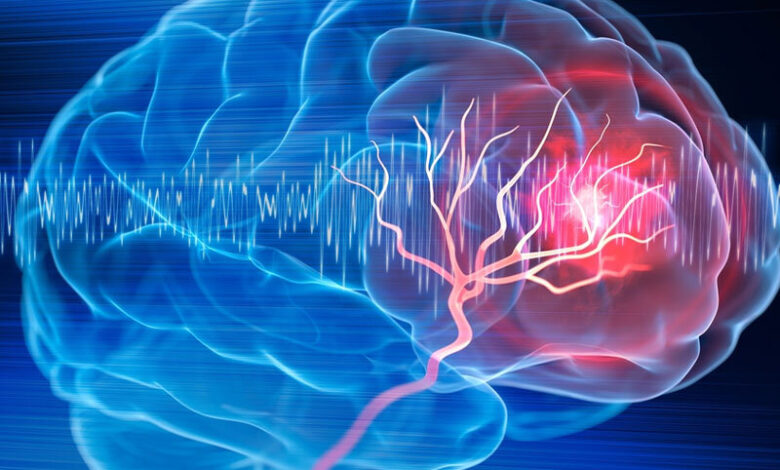 سالانه 150 هزار نفر در کشور دچار سکته مغزی می شوند