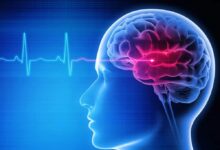 رسیدن سریع به بیمارستان کلید درمان موثر سکته مغزی است