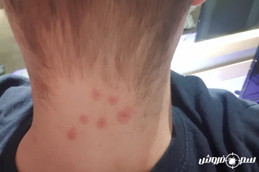 عکس جای نیش ساس در گردن