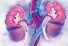 کولیک کلیوی چیست و چگونه تشخیص داده می شود؟