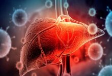 علائم اولیه بیماری های کبدی که اغلب نادیده گرفته می شوند