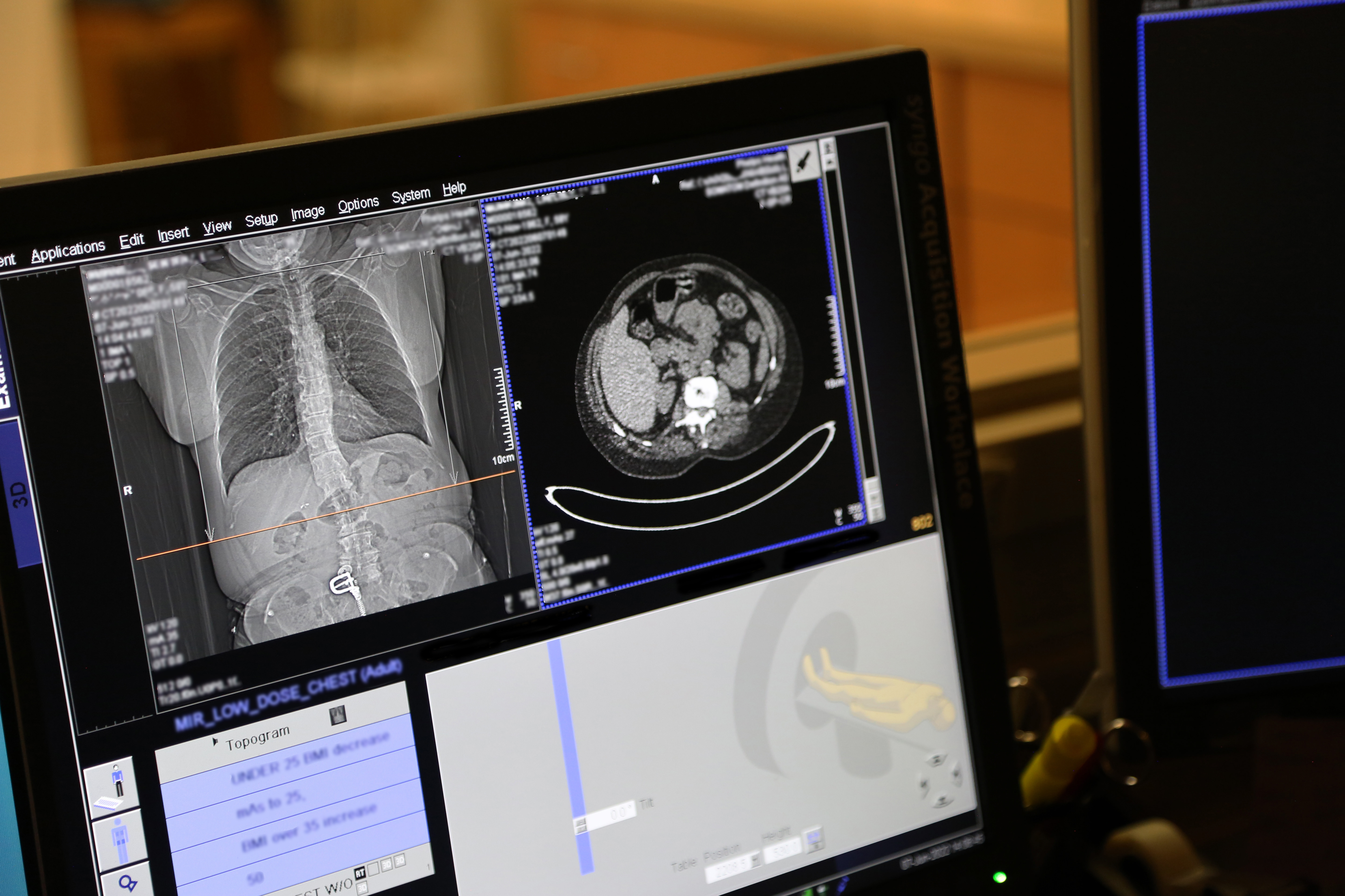 آنچه باید در مورد غربالگری سرطان ریه فلپس هلث بدانید