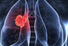 سرطان ریه و علائم همراه با درمان سرطان ریه - کلینیک آروین