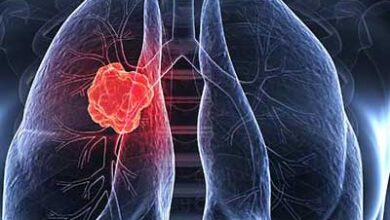 سرطان ریه و علائم همراه با درمان سرطان ریه - کلینیک آروین