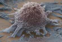 لزوم توجه به تراکم استخوان و جلوگیری از تخریب آن در بیماران سرطانی