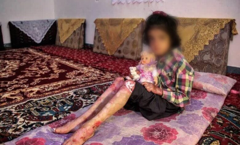 بیماری پروانه‌ای بیشتر در خانواده‌ های دارای ازدواج فامیلی بروز می‌کند