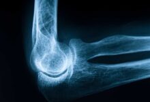 پوکی استخوان؛ زخمی پنهان بر ستون های محکم بدن