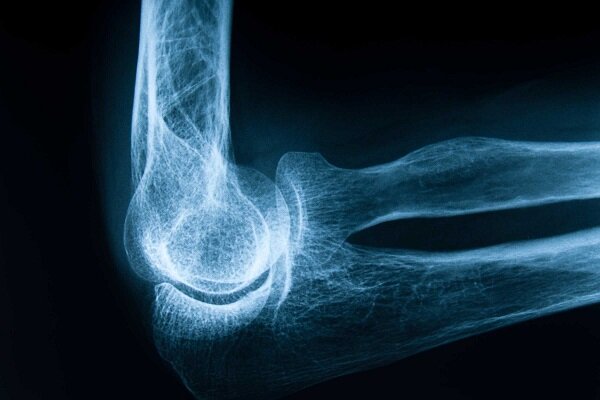 پوکی استخوان؛ زخمی پنهان بر ستون های محکم بدن