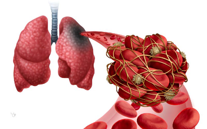 آمبولی ریه چیست و چه خطراتی دارد؟ - مجله سلامت دکتر