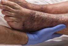 15 درصد دیابتی ها به زخم دیابت مبتلا می شوند - خبرگزاری مهر ایران و جهان