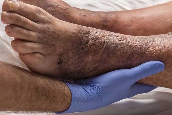 15 درصد دیابتی ها به زخم دیابت مبتلا می شوند - خبرگزاری مهر ایران و جهان