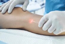 واریس؛ بیماری شایع اما قابل پیشگیری با چند عادت ساده