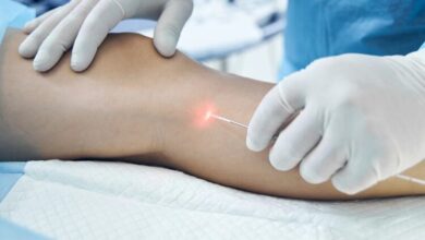 واریس؛ بیماری شایع اما قابل پیشگیری با چند عادت ساده