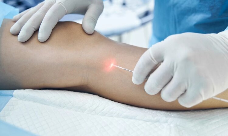 واریس؛ بیماری شایع اما قابل پیشگیری با چند عادت ساده