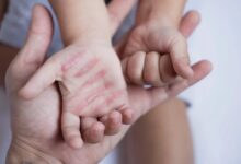 سوختگی؛ آسیب جسمی و روانی که فراتر از درمان است