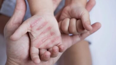 سوختگی؛ آسیب جسمی و روانی که فراتر از درمان است