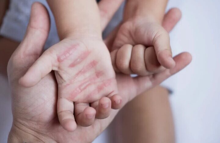 سوختگی؛ آسیب جسمی و روانی که فراتر از درمان است