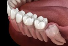 بیماری لثه خطر سکته مغزی را افزایش می دهد - خبرگزاری مهر ایران و جهان