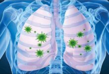 ذات الریه چیست؟ | علائم، علل و روش های درمانی برای پیشگیری و بهبودی سریع