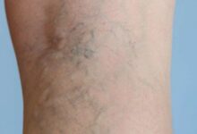 با چند عادت ساده از واریس پیشگیری کنیم - خبرگزاری مهر ایران و جهان