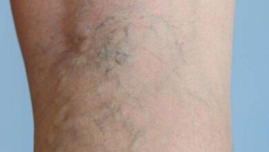 با چند عادت ساده از واریس پیشگیری کنیم - خبرگزاری مهر ایران و جهان