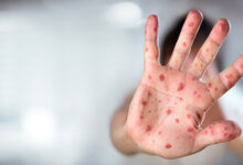 همه چیز درباره شایعه سرخک و سرخجه در کشور واکسیناسیون و اقدامات نظام سلامت