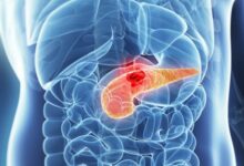 شناسایی علائم هشدار دهنده اولیه سرطان معروف به "قاتل خاموش" - خبرگزاری مهر ایران و جهان