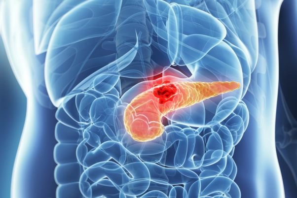 شناسایی علائم هشدار دهنده اولیه سرطان معروف به "قاتل خاموش" - خبرگزاری مهر ایران و جهان