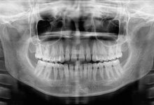 رادیوگرافی دندانی در دوران بارداری بی‌خطر است؛ رعایت اصول ایمنی ضروری است