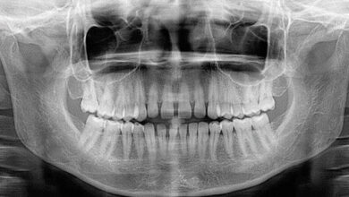 رادیوگرافی دندانی در دوران بارداری بی‌خطر است؛ رعایت اصول ایمنی ضروری است