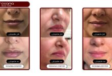 هیپوتراپی صورت