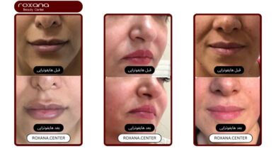 هیپوتراپی صورت