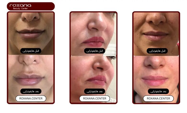 هیپوتراپی صورت