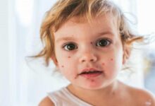 افزایش شیوع سرخک در کشور