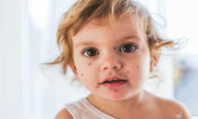 افزایش شیوع سرخک در کشور