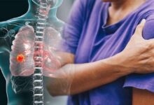 شانه یخ‌زده چیست؟ - خبرگزاری سلامت