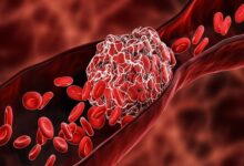 چربی خون بالا؛ دشمن خاموش رگ ها - خبرگزاری مهر خبر ایران و جهان