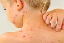 افزایش موارد سرخک در جهان به دلیل کاهش میزان واکسیناسیون - خبرگزاری مهر ایران و جهان