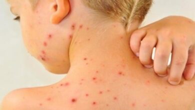 افزایش موارد سرخک در جهان به دلیل کاهش میزان واکسیناسیون - خبرگزاری مهر ایران و جهان