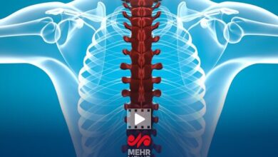 فلج اندام یکی از عوارض شکستن کالانجا توسط ماساژور است - خبرگزاری مهر ایران و جهان