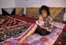 بیماران پروانه ای نیازمند حمایت دولت برای دسترسی به داروهای گران قیمت هستند