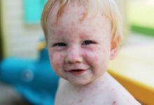 هیچ درمان ضد ویروسی برای سرخک وجود ندارد