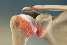 نگرانی بیماران از انجام جراحی تعویض مفصل زانو آیا این جراحی برای بیماران دیابتی خطرناک است؟